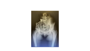 Osteosarkom, ewing sarkom, kemik tümörü, yumuşak doku sarkomu, ortopedik tümör, korhan özkan